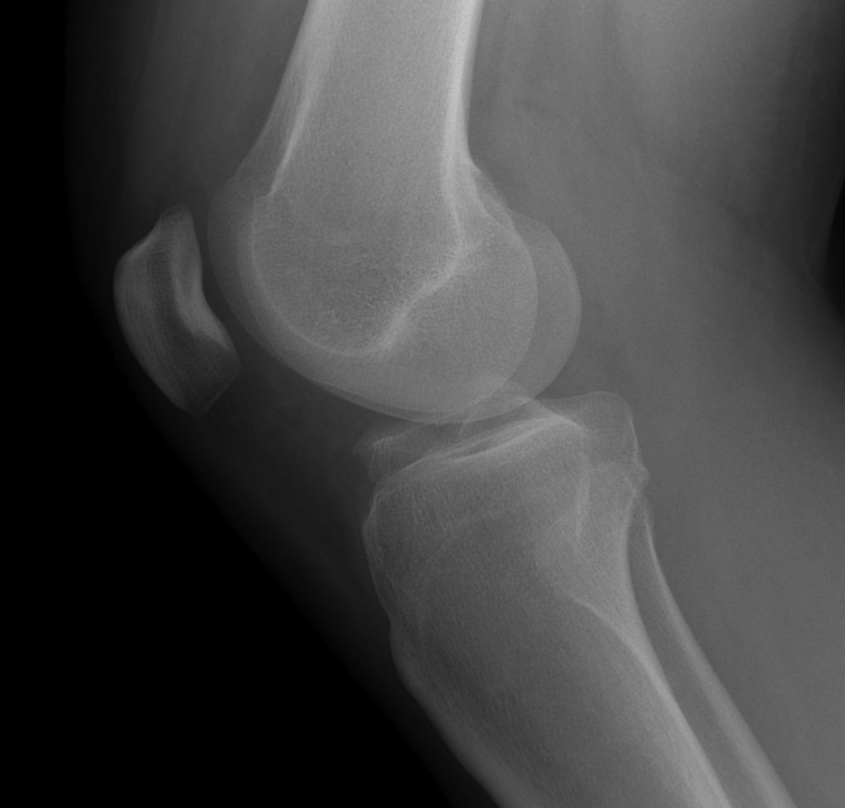 ACL Bony Avulsion Xray